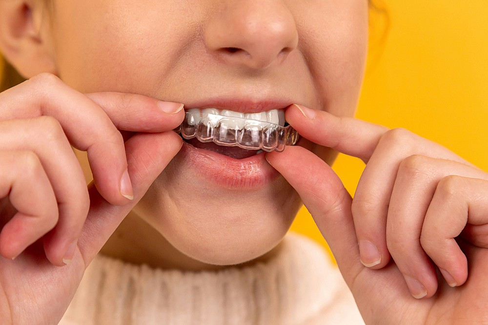 Combien de séances pour un implant dentaire : comprendre chaque étape avant de se lancer